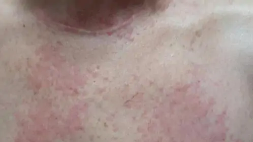 Três cidades do sertão de Pernambuco notificam casos de coceira misteriosa