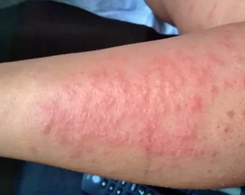 Mais uma cidade do Sertão registra caso de coceira misteriosa