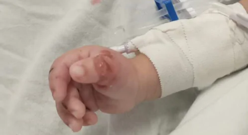 Bebê torturado por mãe e companheira tinha marcas de bituca de cigarro