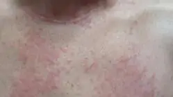 Três cidades do sertão de Pernambuco notificam casos de coceira misteriosa